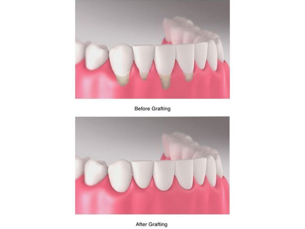 can grinding teeth cause gum recession